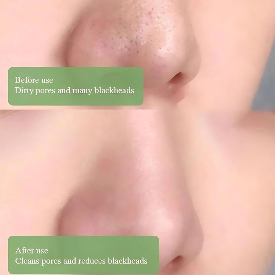 Dermasuction Blackhead Remover (50% OFF Today)