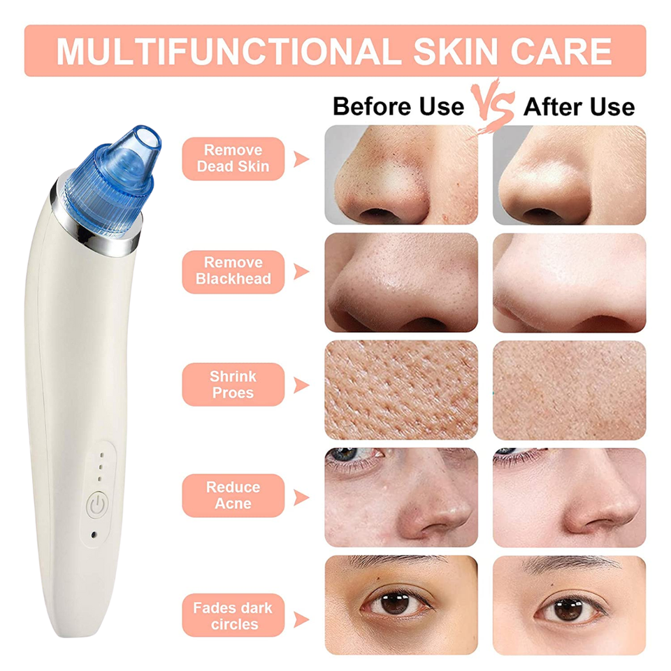 Dermasuction Blackhead Remover (50% OFF Today)